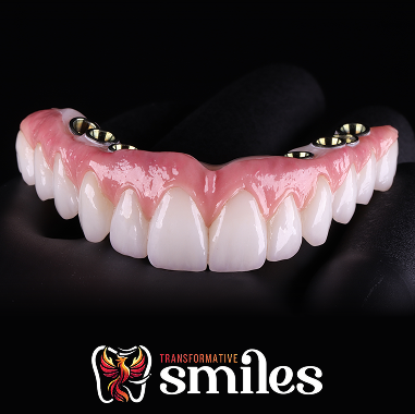 Hybrid Implant Bridge
