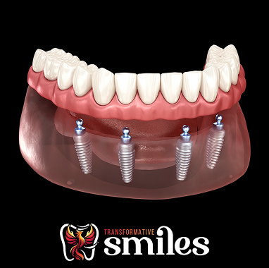 Zirconia Implant Bridge